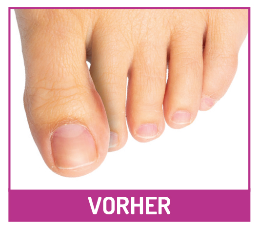 fu-gut-sv128-zehen-distanz-schiene-weiche-silikon-zehentrenner image 2