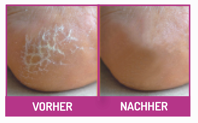fu-gut-432-hornhaut-reduzier-balsam-f-r-fu-hand image 3